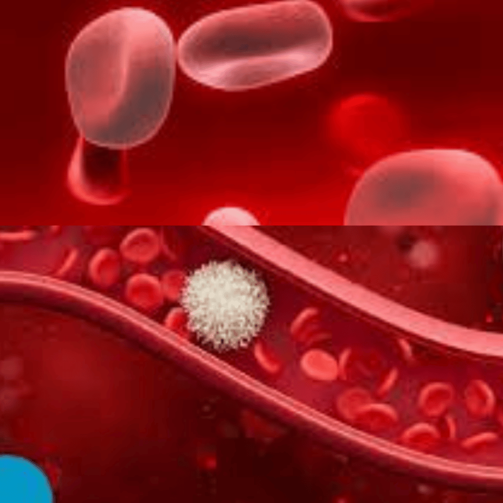 Anemia