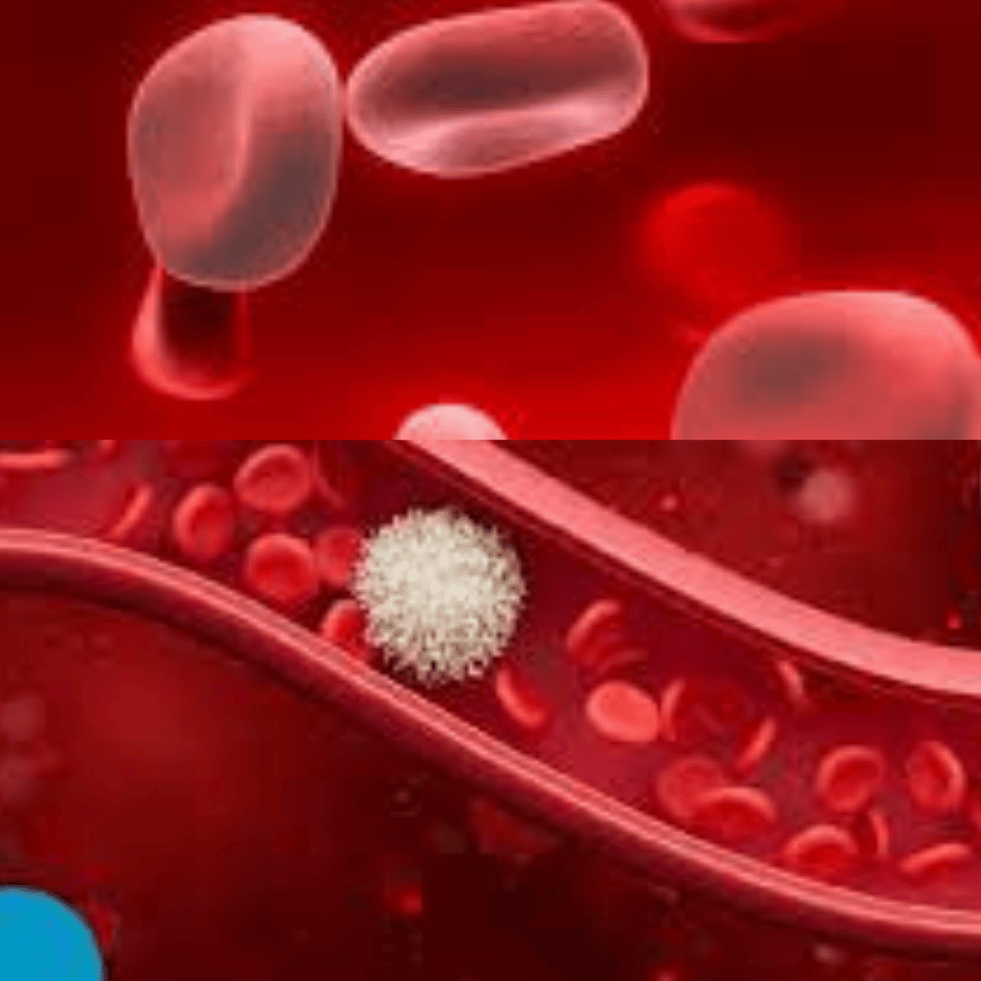 Anemia