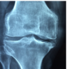 Osteoarthritis Treatment