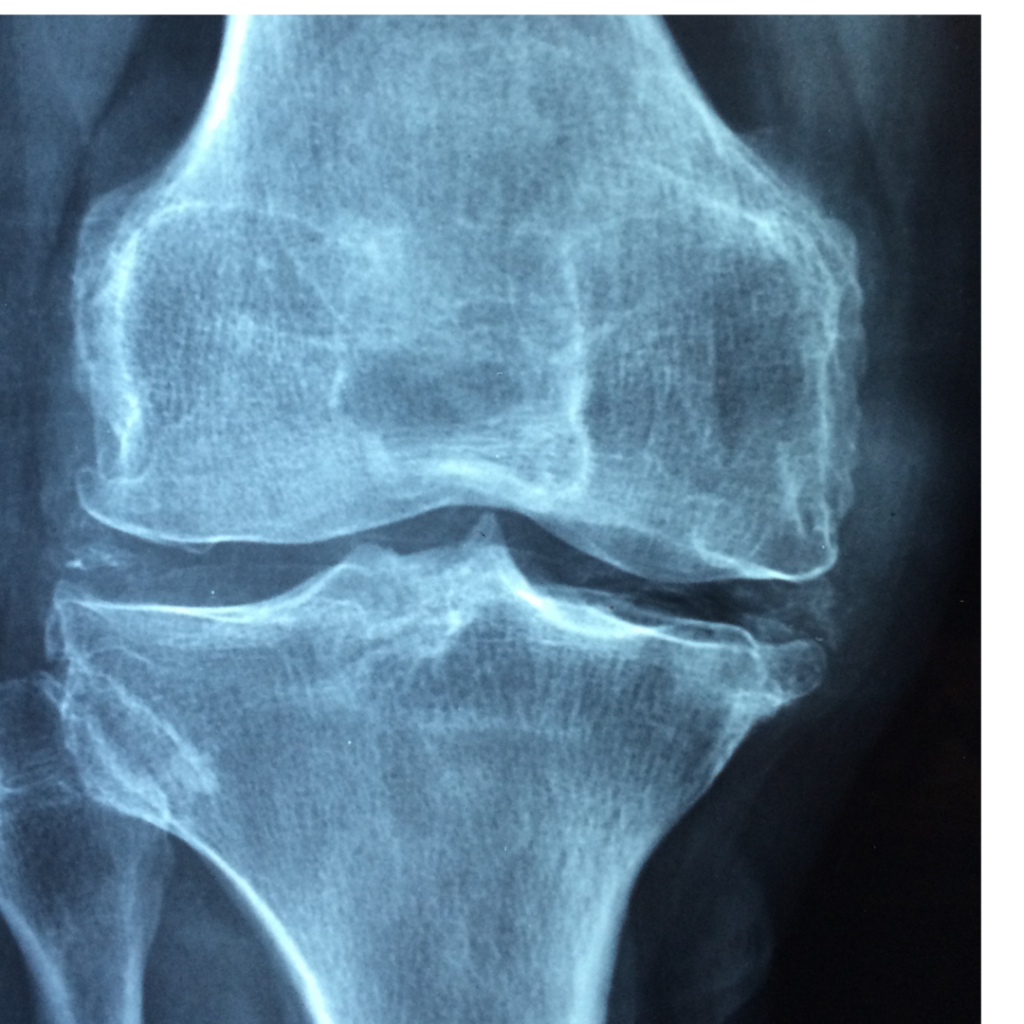 Osteoarthritis Treatment