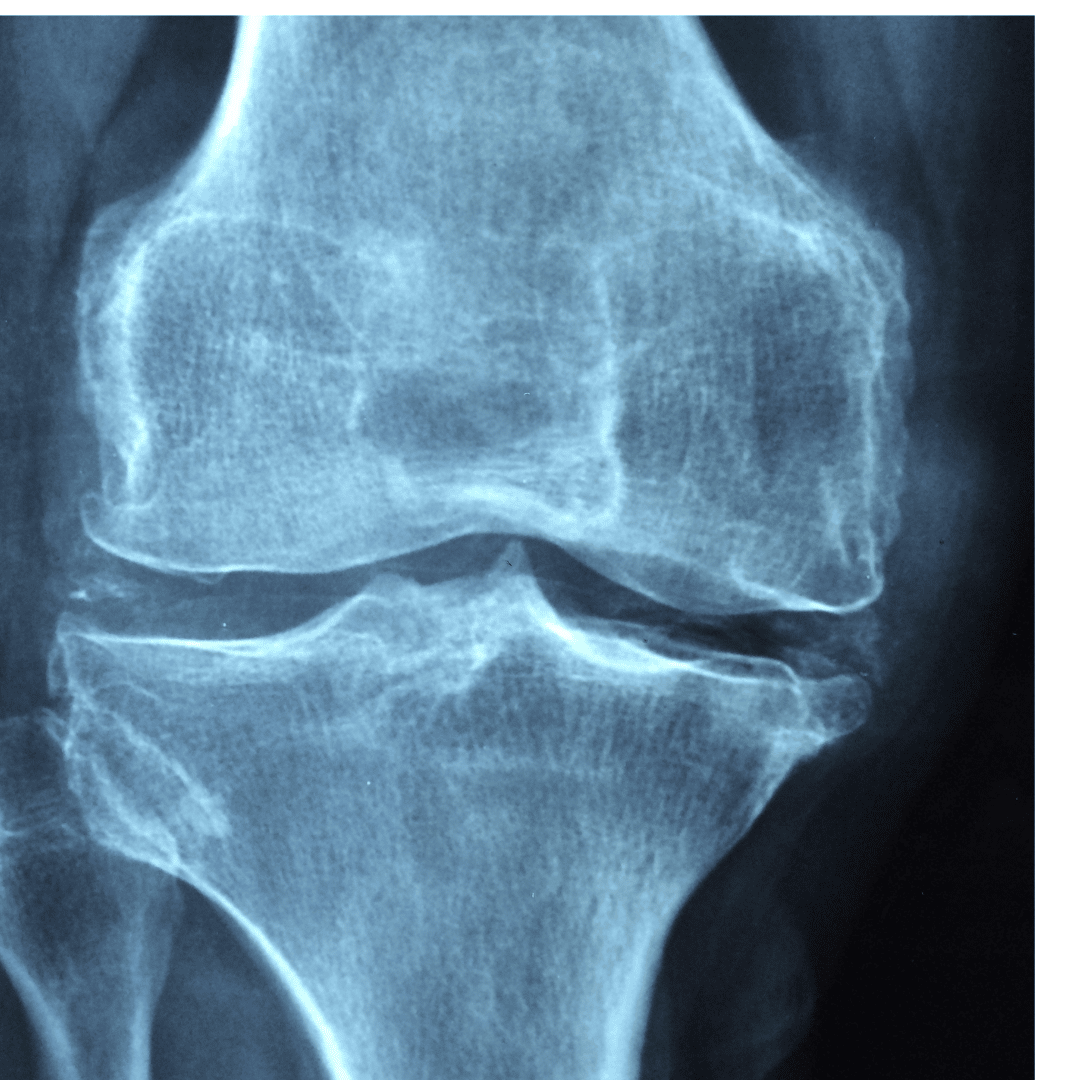 Osteoarthritis Treatment