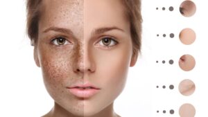Ayurvedic Treatment For Pigmentation On The Face