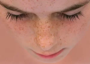 Ayurvedic Treatment For Pigmentation On The Face